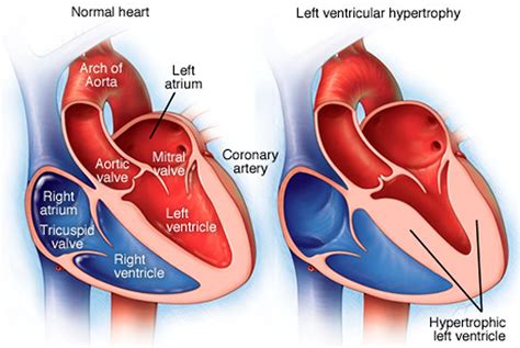 what is severe concentric left ventricular hypertrophy